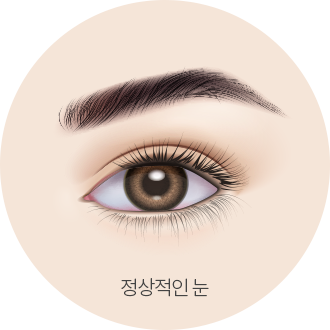 더웰병원 안검하수는 눈매교정술로!