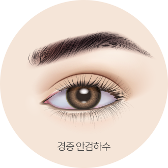 더웰병원 안검하수는 눈매교정술로!