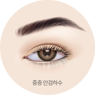 더웰병원 안검하수는 눈매교정술로!
