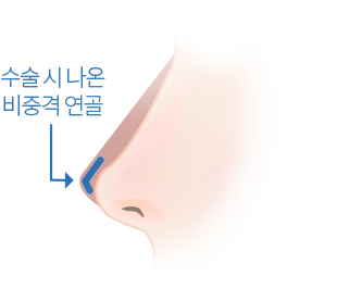 더웰병원 비중격만곡증의 치료