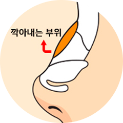 더웰병원 매부리코 수술 방법