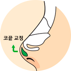 더웰병원 매부리코 수술 방법