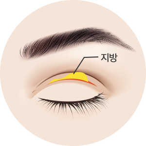 더웰병원 쌍커풀 절개 수술
