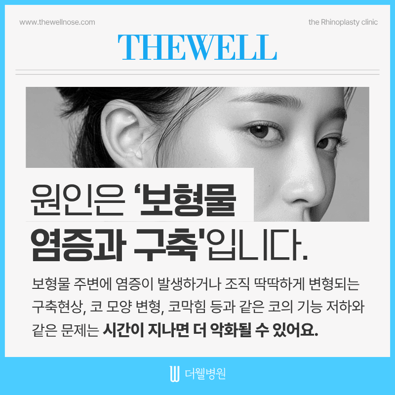 수원코재수술, 코보형물제거수술, 코보형물부작용, 더웰병원성형외과
