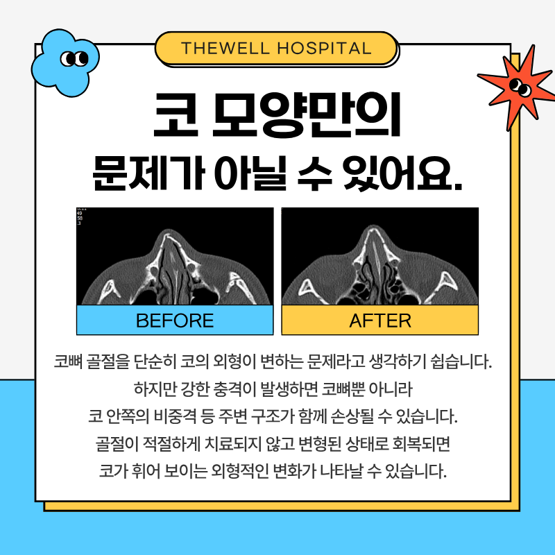 수원더웰병원, 코뼈골절, 코뼈골절수술, 어린이코뼈골절